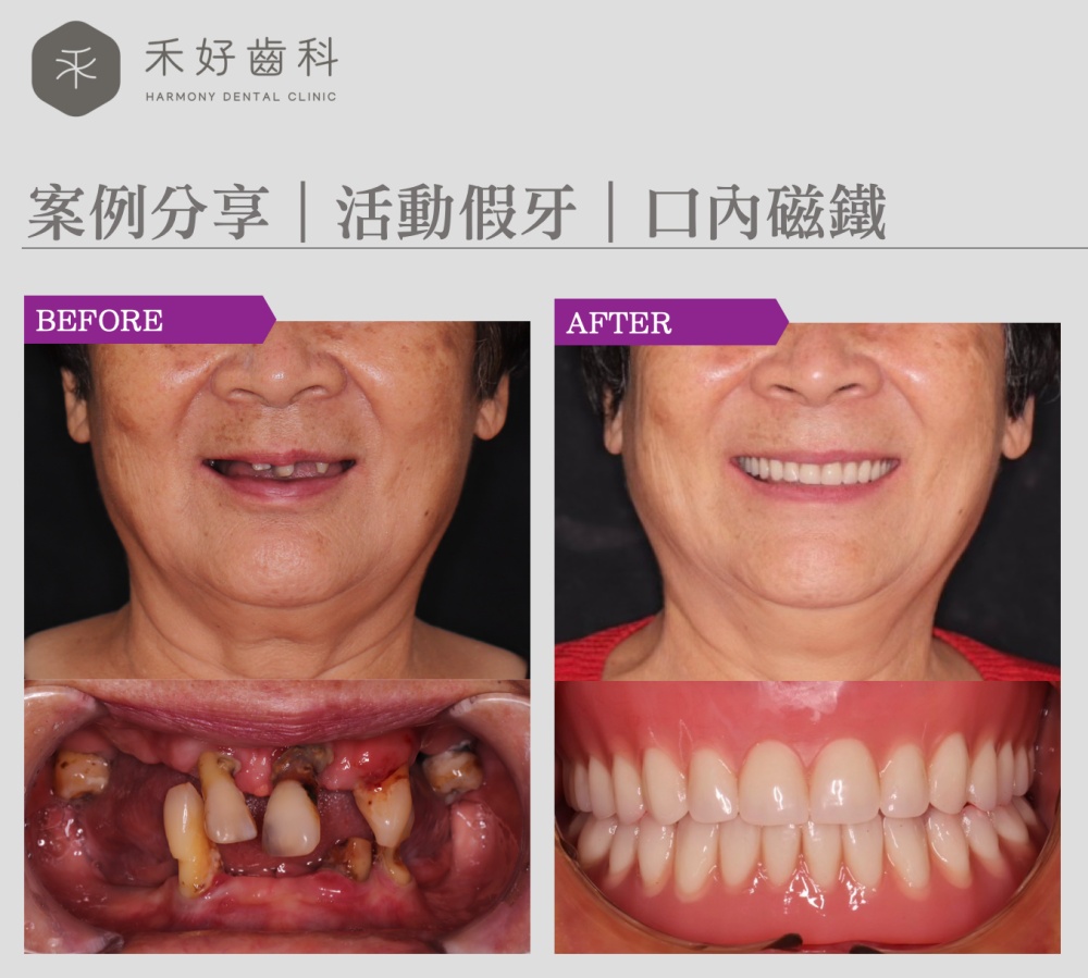 禾好齒科 案例分享 活動假牙 口內磁鐵