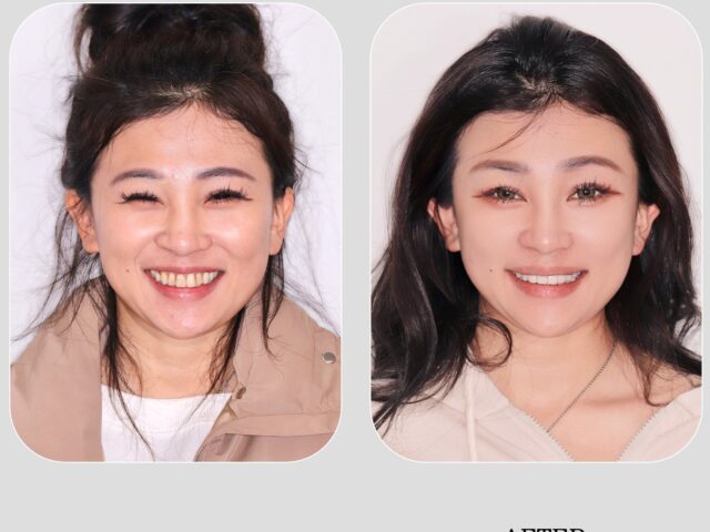 全瓷冠前牙美學 重回我的白皙自信