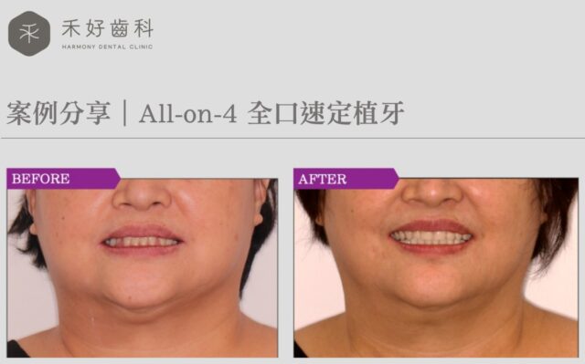 Rapid dental implant
