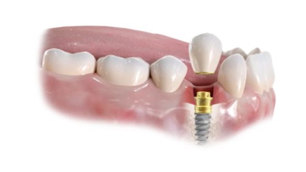 https://www.harmonydc.com.tw/wp-content/uploads/2025/07/teeth-01.jpg