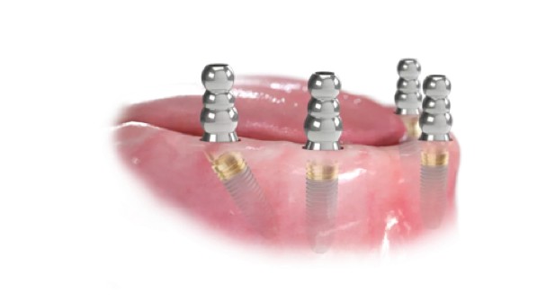 https://www.harmonydc.com.tw/wp-content/uploads/2025/07/teeth-02.jpg