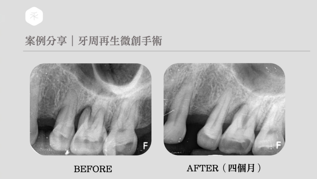 牙周再生微創手術（BAn4個月）