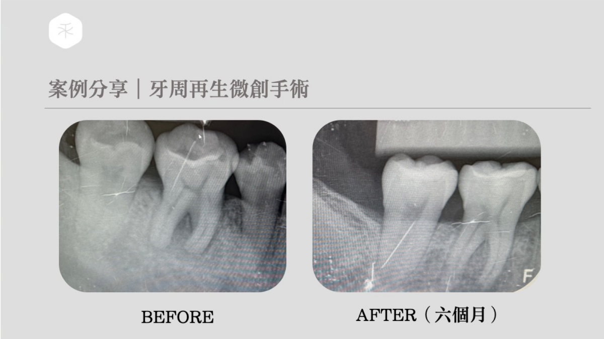 牙周微創再生手術（BAn6個月）