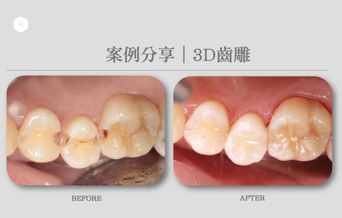 3D齒雕案例